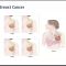 Breast Cancer: Overview for Everyone by Muhammad Usama J